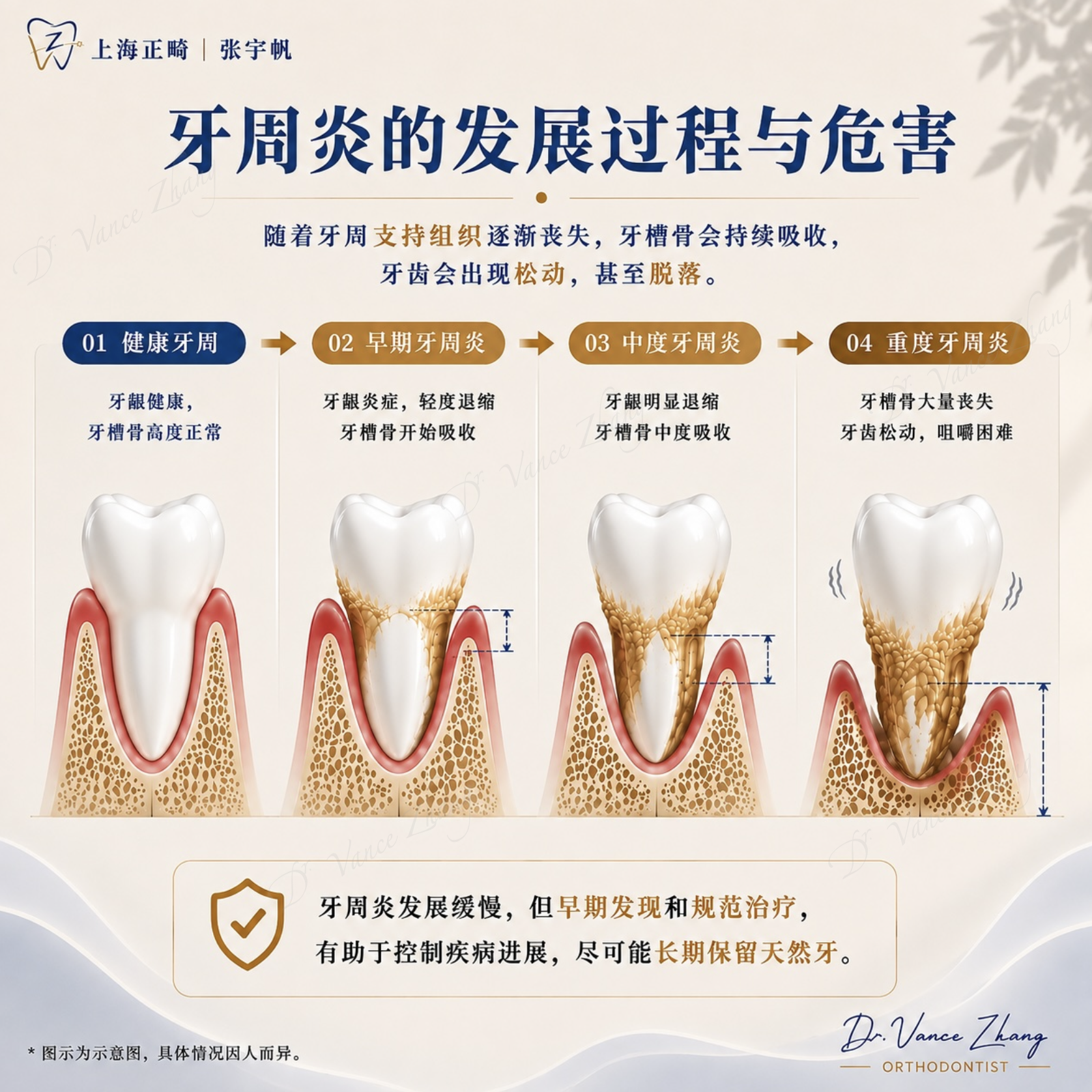 牙周炎进展与危害示意图