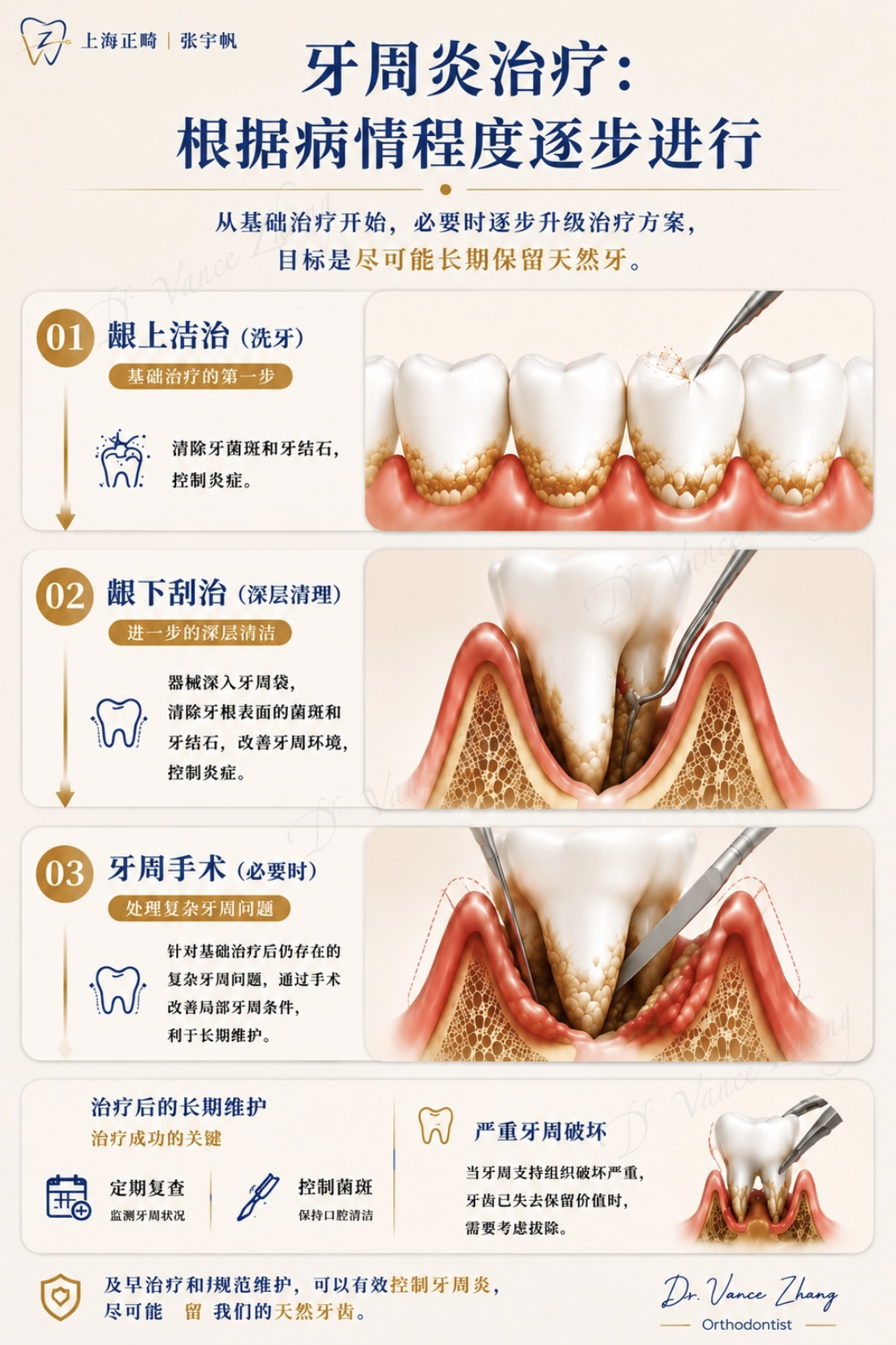 牙周炎分阶段治疗示意图